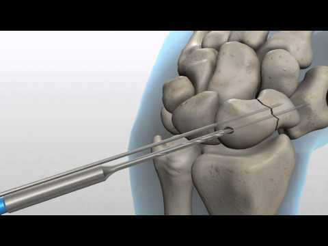 Acutrak 2.0 screw for a Scaphoid Hand Fracture