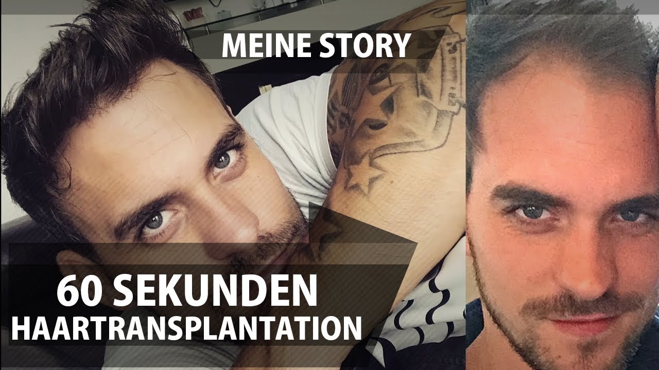 60 Sekunden - Meine Haartransplantations Story