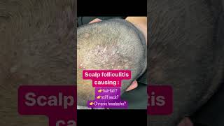 Scalp boils |Scalp folliculitis Treatment| Hairfall treatment | Dermatologist in Punjab #shorts