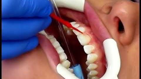 3M UNITEK GEMINI CLEAR BRACKETS - How To Use - DENTBEAR