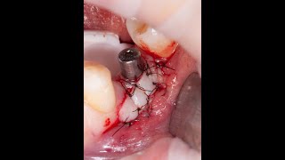 Keratinized tissue improvement around dental implant. screenshot 1