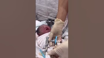 Cut the umbilical cord slowly - Cắt dây rốn chắc anh cho em bé #baby #babyshorts #newbornbaby #embe