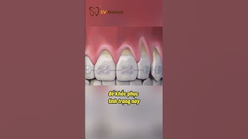 TẠI SAO NIỀNG RĂNG XONG LẠI BỊ TỤT LỢI? 4 Nguyên Nhân Phổ Biến Nhất | Nha Khoa SV Giải Đáp