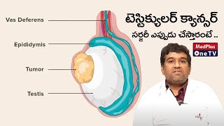 Testicular Cancer Surgery: When and Why? | Dr.Raghavendra Rao @MedPlusONETV