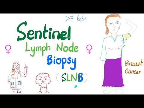 Sentinel Lymph Node Biopsy (SLNB) for Breast Cancer