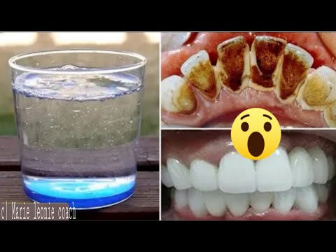 Formule Secrète du Dentiste Chinois:RINCE-BOUCHE /retirez la plaque dentaire en 2 Minutes