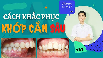 Khớp Cắn Sâu Là Như Thế Nào | Cách Khắc Phục Khớp Cắn Sâu