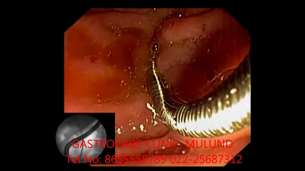 Endoscopic extraction of deeply migrated biliary stent using over the wire snare technique