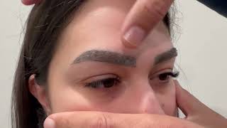 Result of eyebrow transplant