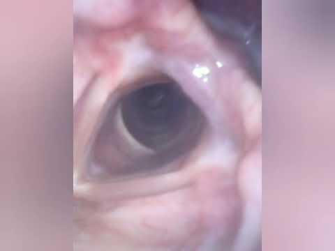 Endoscope Vore