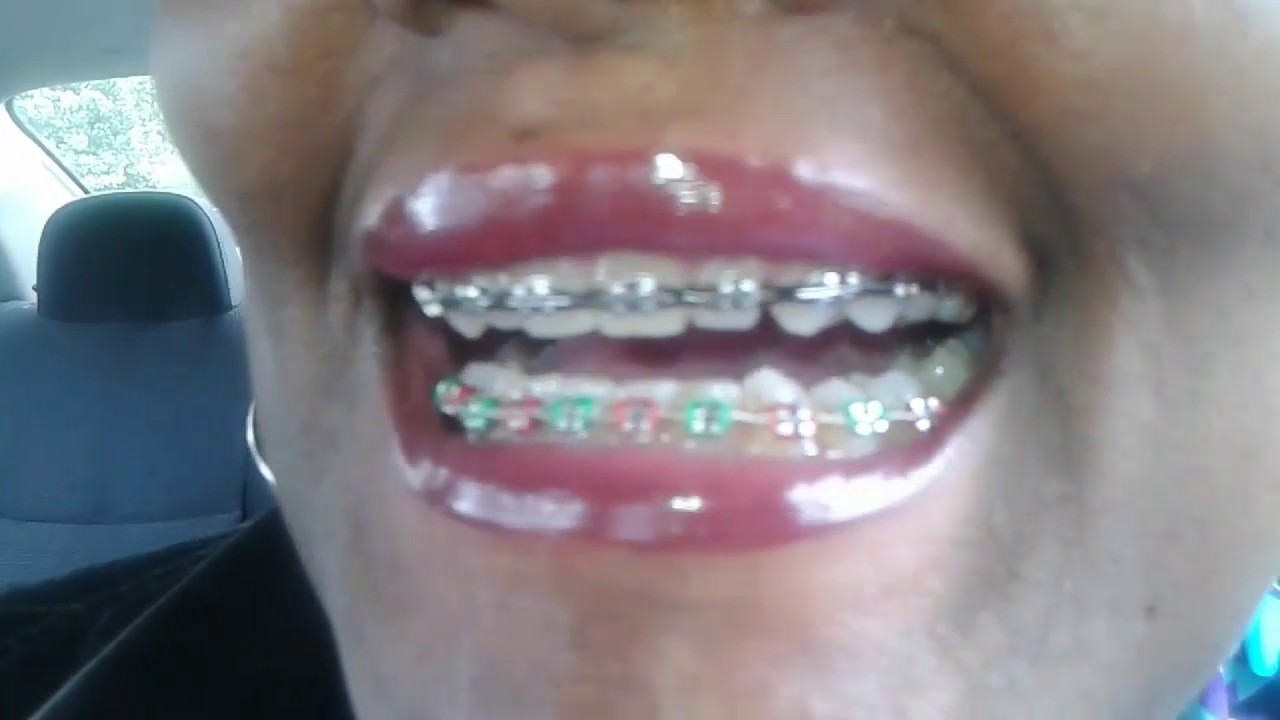 Adult Braces 💕Traditional Braces 14th Adjustment💕 YouTube