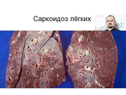 Саркоидоз лёгких – что это такое