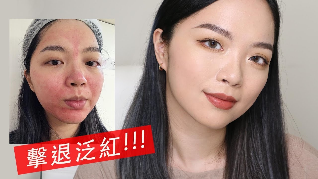 全記錄 打皮秒要求下重手凹疤臉出血秒變關公 蜂巢皮秒皮下出血