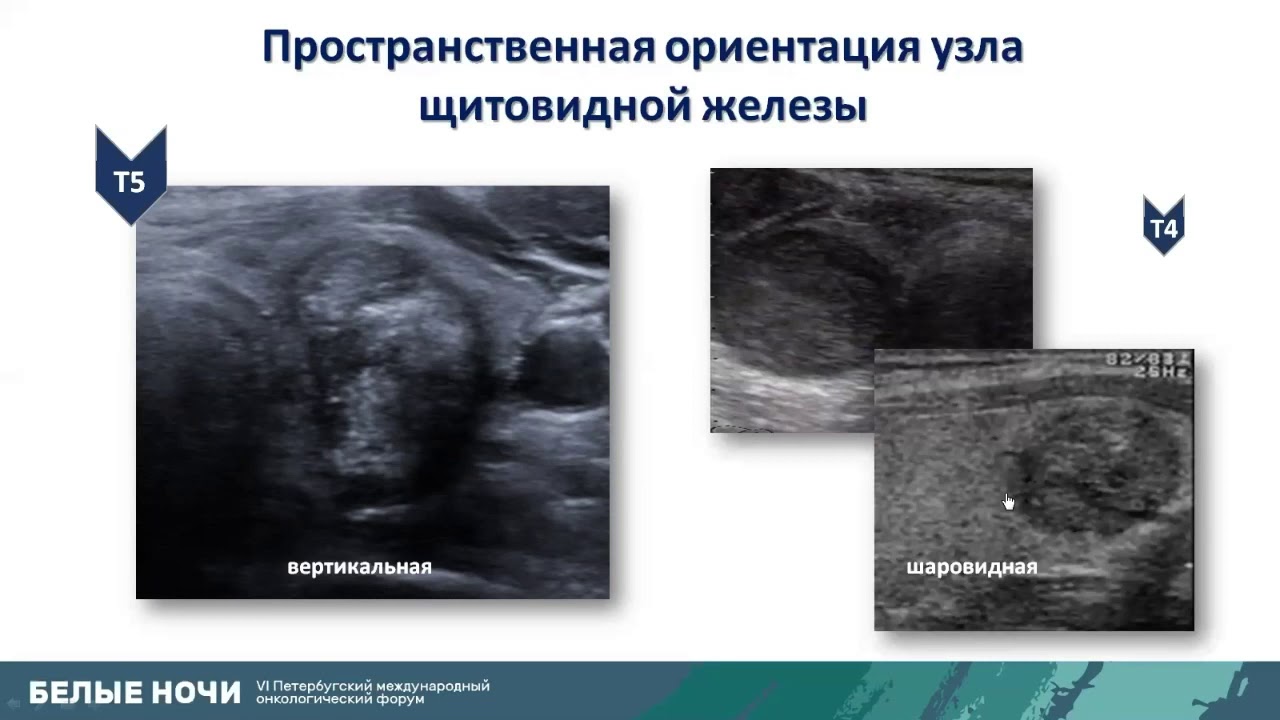 Классификация TI-RADS. Стратификация очаговых образований щитовидной железы. Российская версия