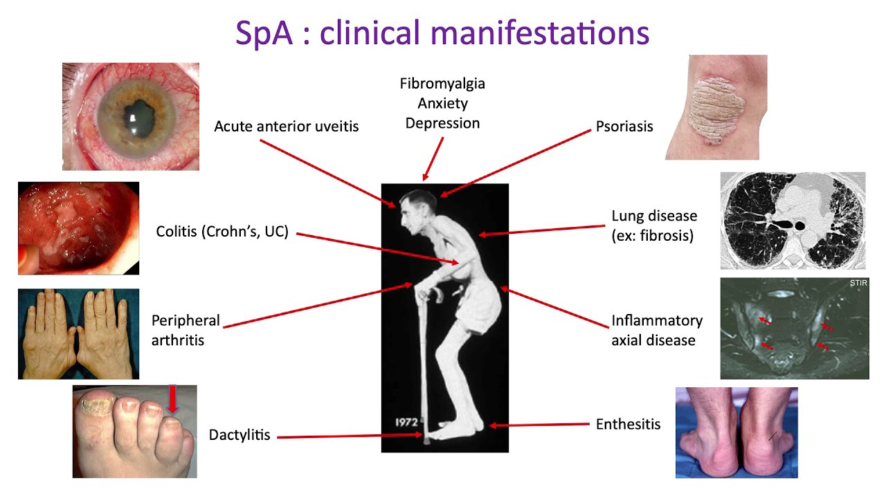 Nouveautés dans les Spondylarthrites