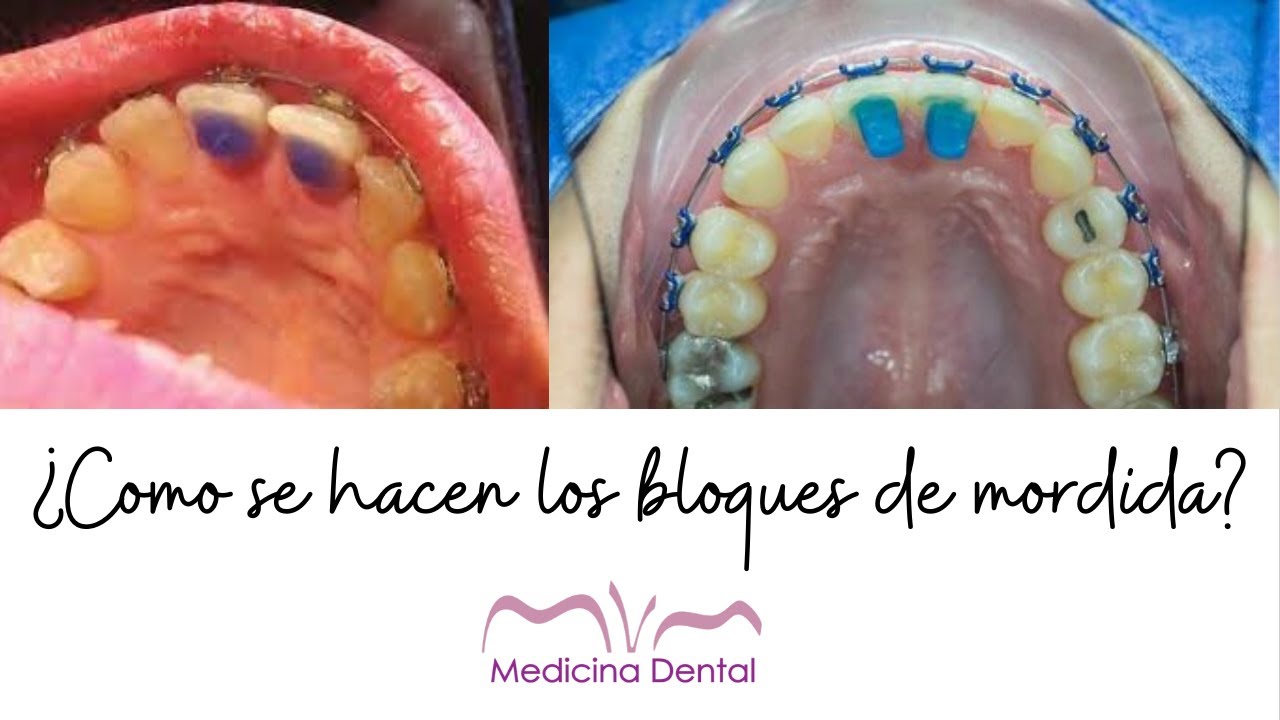 ¿Como se fabrican los TOPES de MORDIDA?