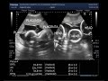 Ultrasound Video showing Triplet Pregnancy with three separate placentas.