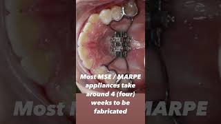 How to get an MSE #mse #marpe #airway