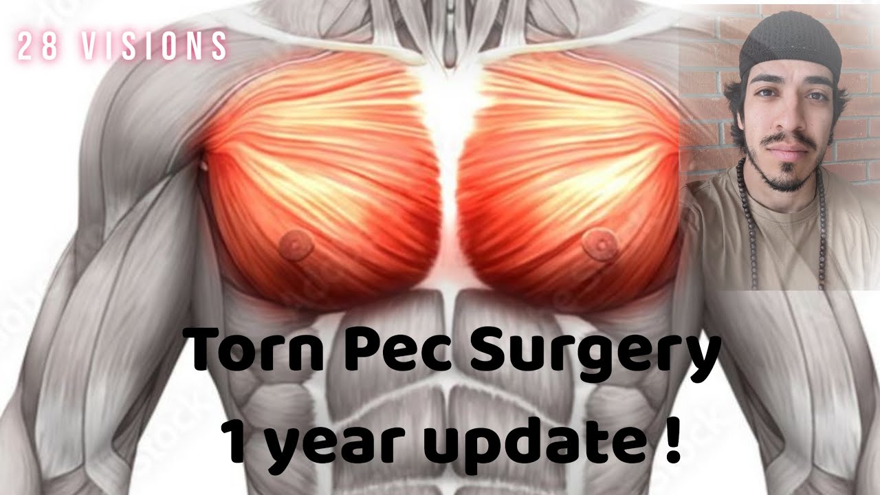 Torn Pec Surgery! (one year update) YouTube