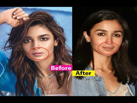 Alia Bhatt Lip Job - Before And After - YouTube