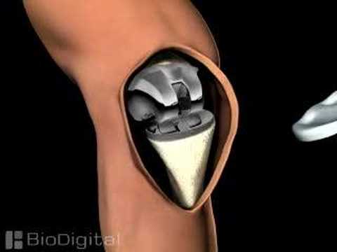 3D Medical Animation of a Knee Replacement - YouTube