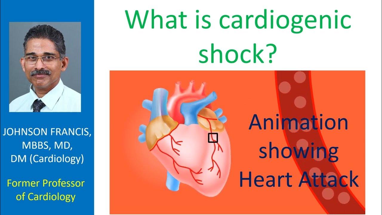 What Is Cardiogenic Shock YouTube what-is-cardiogenic-shock-youtube
