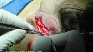 How Nose Surgery is Performed - Ear Cartilage Harvest - Nose Job