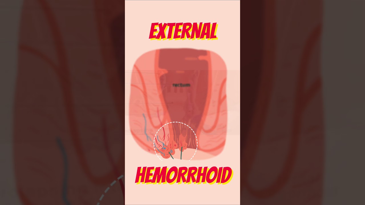 Alamin ang Sakit na Almoranas- By Dr. Ramon Estrada and Doc Willie Ong