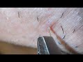 Plucking facial hair & ingrown hair 1300 頬髭抜き(埋没毛あり)