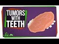 Teratomas what tumors with teeth can teach us about stem cells