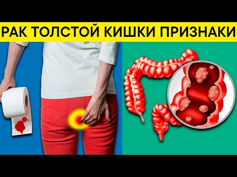 РАК Толстой Кишки. 13 Признаков того, что в Вашем теле растет РАК Толстой Кишки. Как снизить риск?