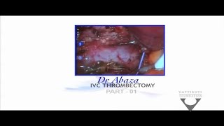 Dr. Ronney Abaza:  IVC Thrombectomy