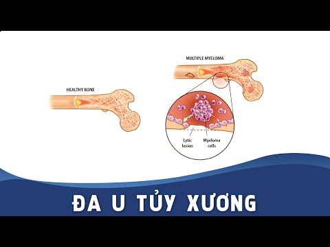 Video: 3 cách chăm sóc cơ thể khi bạn bị đa u tủy