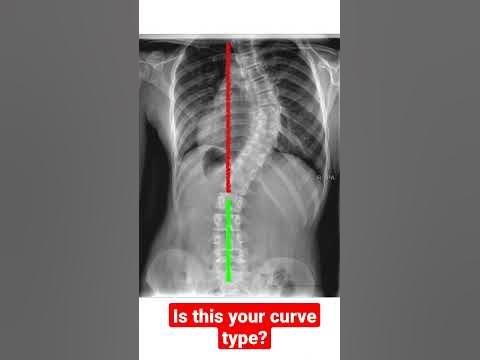 Do you have dextroscoliosis? #backpain #scoliosis #dextroscoliosis ...