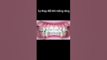 Kết quả trước và sau khi niềng răng hô tại Up Dental