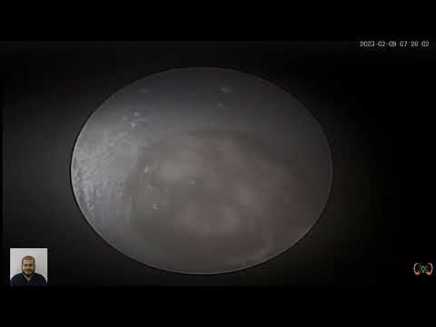 تفتيت واستخراج حصوه من الكلى بالمنظار الدكتور يسرى ابو على