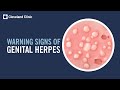 5 warning signs of genital herpes