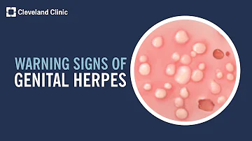 5 Warning Signs of Genital Herpes