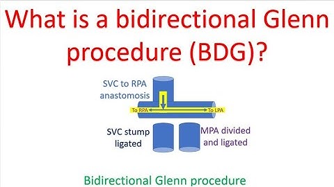 What is a bidirectional Glenn procedure (BDG)?