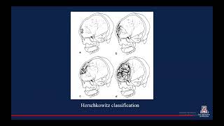 Imaging Characteristics of Hyperostosis Frontalis Interna