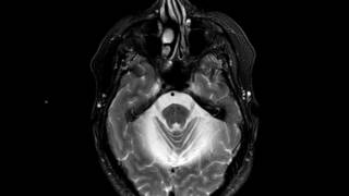 Multisystem Atrophy