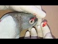 أول عملية جراحية في قناة عالم الطيور استئصال كيس دهني قرب العين مكان حساس دقق في الشرح داخل الفيديو