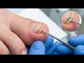 The best Method of Ingrown Toenail Removal Part1