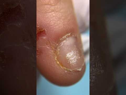 ¡Las uñas mordidas