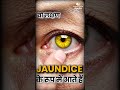 पीलिया और Alcoholic Jaundice में क्या फर्क है? | Liver Damage Symptoms.