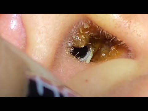 ASMR Ear Cleaning – The Most Horrifying Extraction We've Ever Filmed