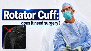 Rotator Cuff Tear: When Surgery is Your Best option