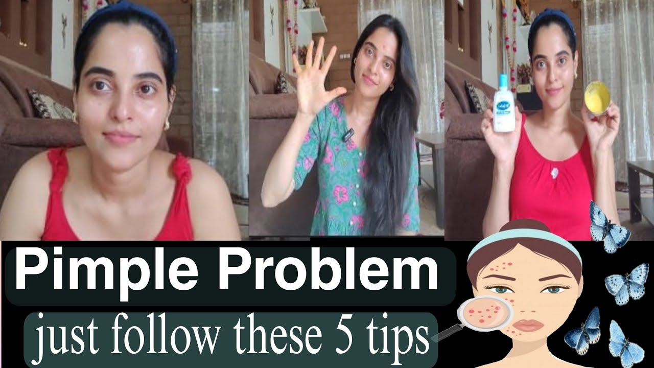 Pimple Problems ಇದ್ದವರು ಈ 5 tipsಅನ್ನು follow ಮಾಡಿ ಸಾಕು#pimple #clearskin #skincare #acne #benatural