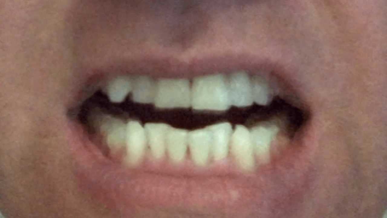 My Invisalign Experience In Dodge City morph Of Teeth YouTube