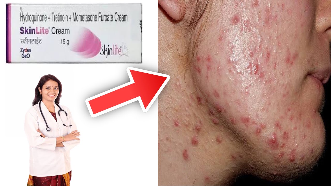Skin lite cream se side effects kaise thik kare | Full Information